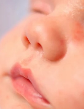 Angioedema