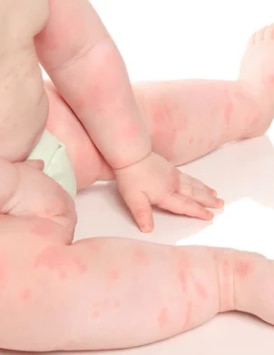 Urticaria